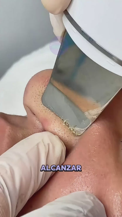 Espátula Ultrasónica Facial – Limpieza Profunda Profesional